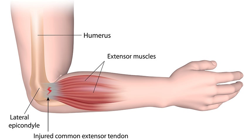 how to sleep with tennis elbow